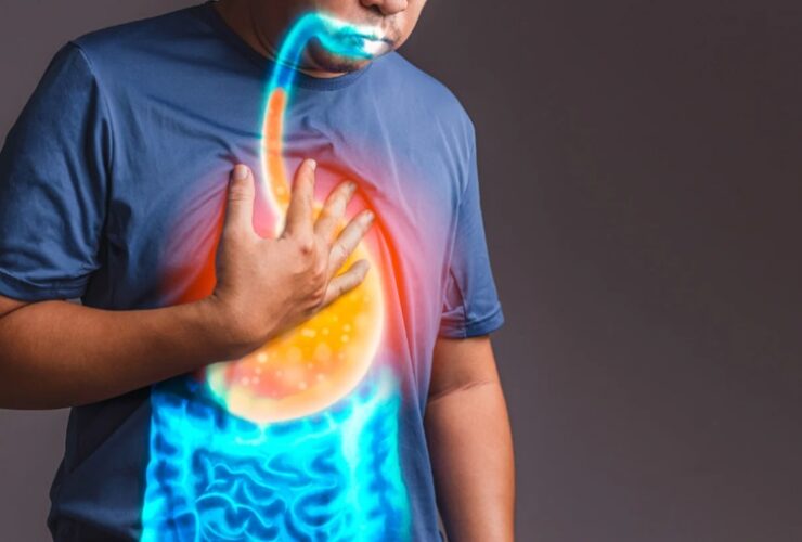 About Acid Reflux and GERD